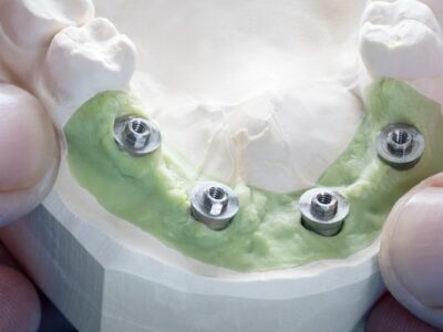 <strong>5 Essential Things to Do Before the Dental Implant Treatment </strong> Dental Implant Treatment