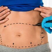 Tummy Tuck