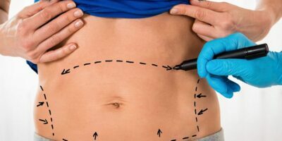 Tummy Tuck