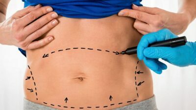Tummy Tuck