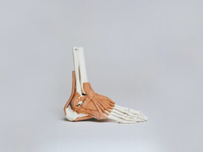 Bone Spurs
