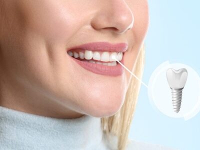 Top Benefits of the Best Possible Method to Replace Lost Teeth Teeth