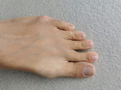Tailor's Bunion