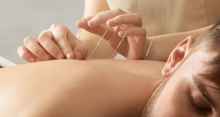 History and Origin of Acupuncture Acupuncture