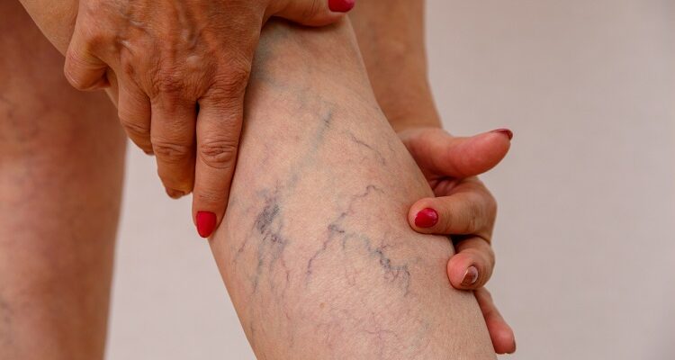 Preventing Vascular Diseases: Tips From Surgeons Vascular Diseases